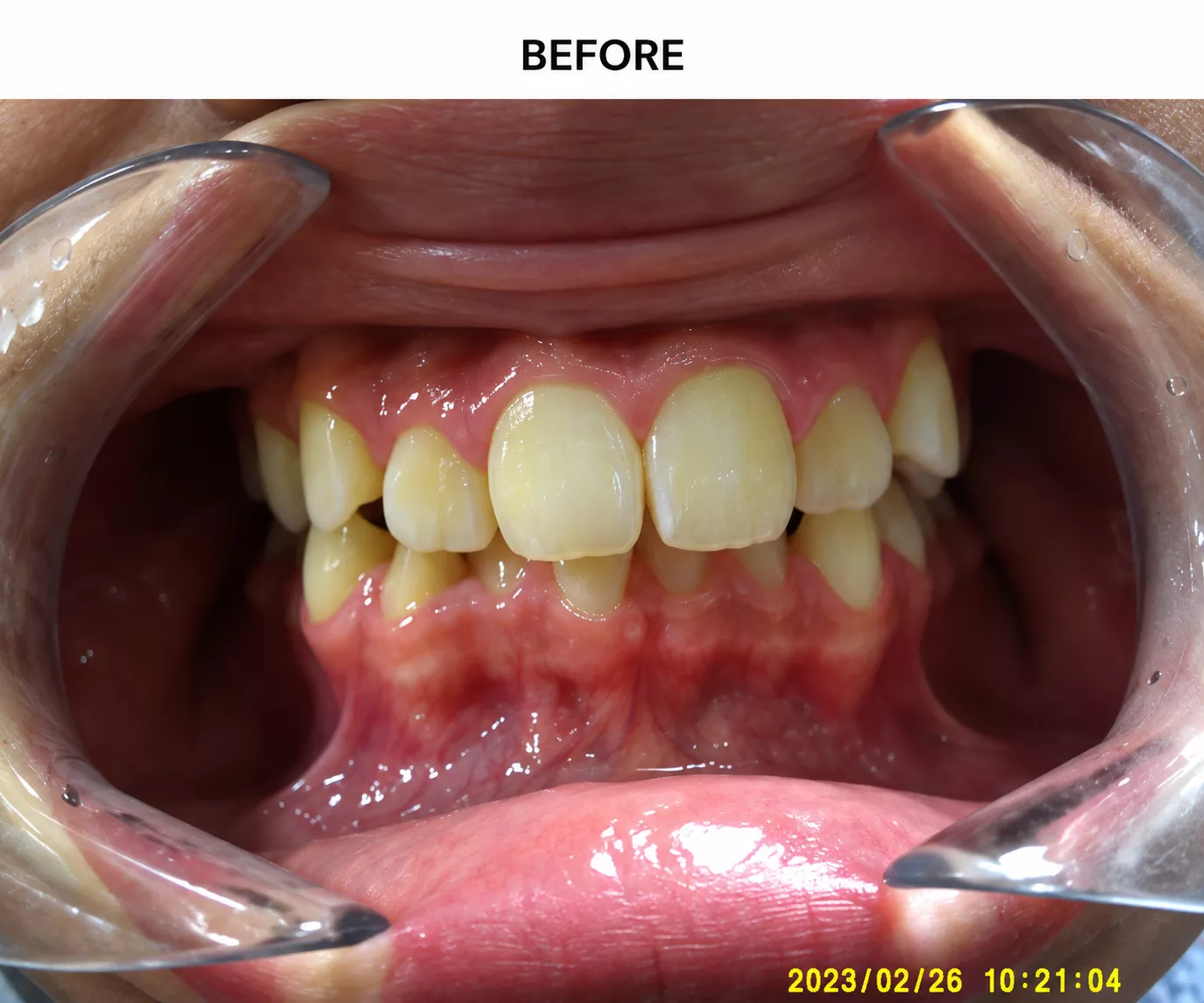4before-6ab45ae0695cc